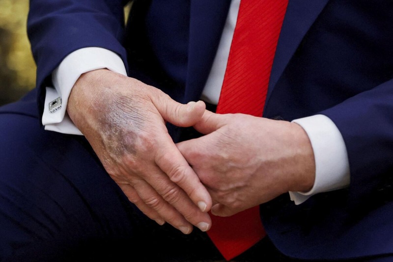 Çox əl sıxmaq, yoxsa aspirin? Trampın biləyindəki sirr