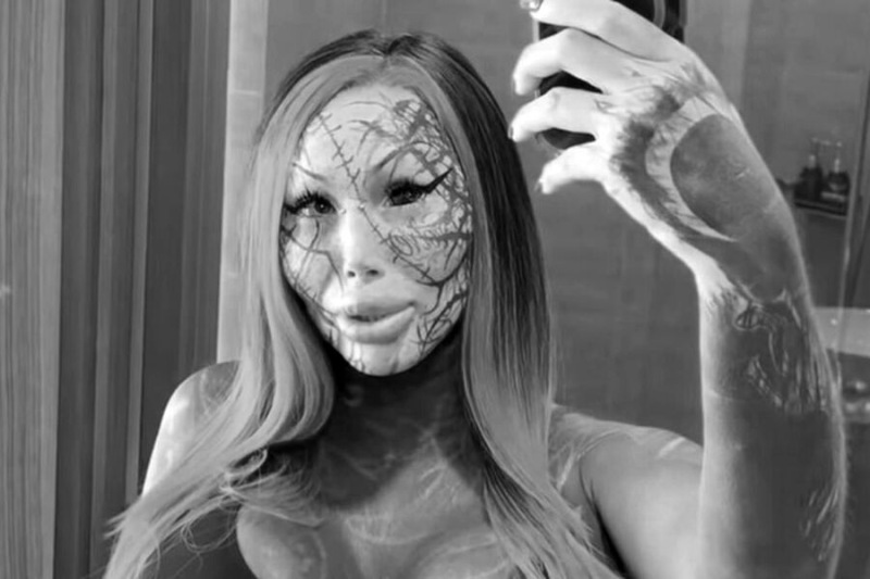 Ekstremal plastik əməliyyatları ilə tanınan bloqer faciəvi şəkildə həyatını itirdi